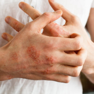 Curing Eczema