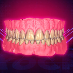 Orthodontic corticotomy. The clinical use of corticotomy and guided bone regeneration